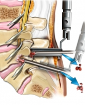 Percutaneous Discectomy